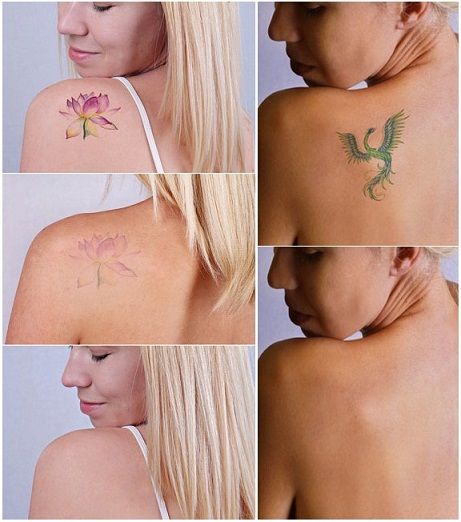 tetoválás removal