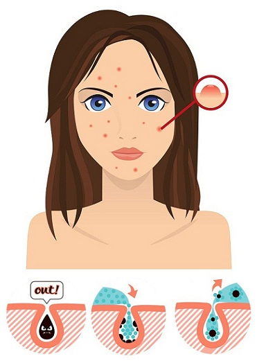 kaip to get rid of pimples