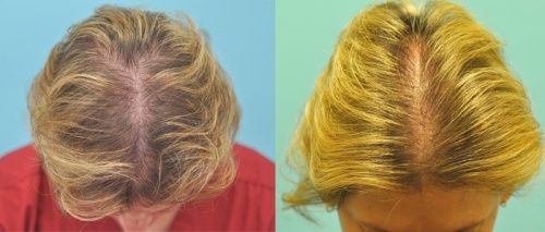 5 Effective Hair Growth Therapy Treatments | Styles At Life