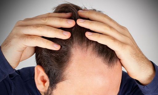 hair loss at temple area