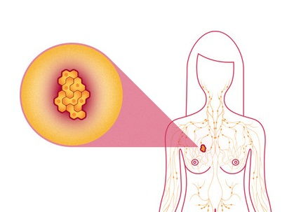 Breast Cancer Treatment types in india