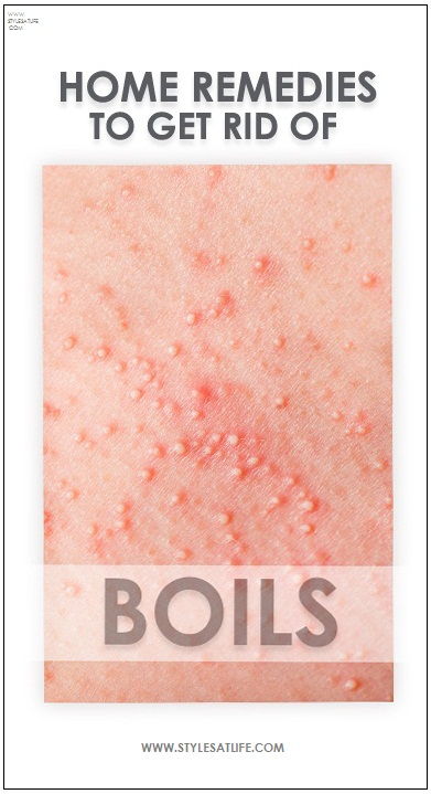 Home Remedies For Boils
