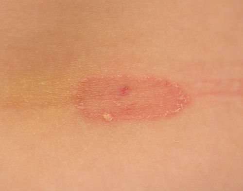 itthon remedies for ringworm