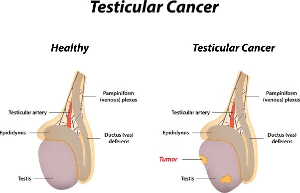 testiculară Cancer Symptoms