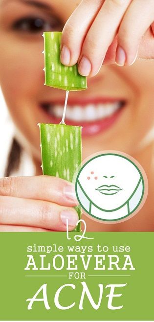 Aloe Vera For Acne - How To Use It