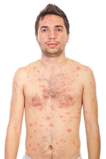 chicken-pox-symptoms-and-causes