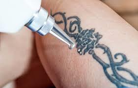 Lahko Permanent Tattoo be Removed? Laser Treatment