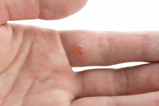 home remedies for warts