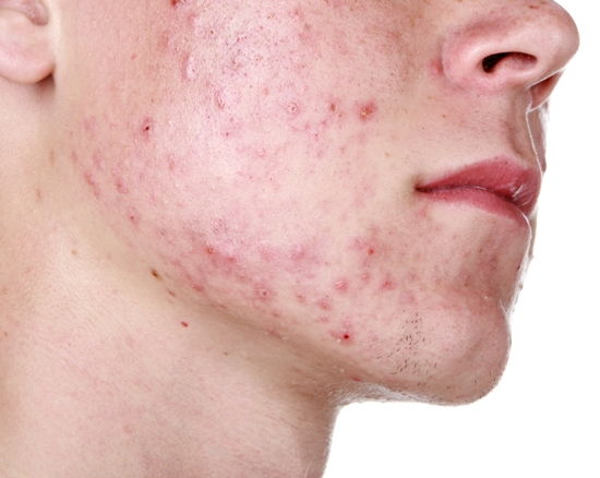 hormonsko acne