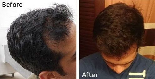 Mustard Oil for Regrowth of Hair with Cure for Greying Hair