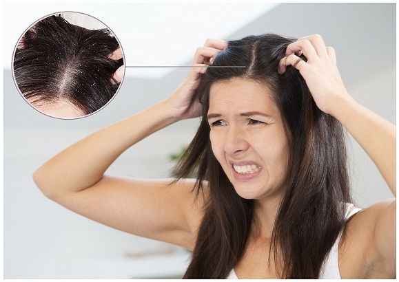 tippek for How To Get Rid Of Dandruff Fast