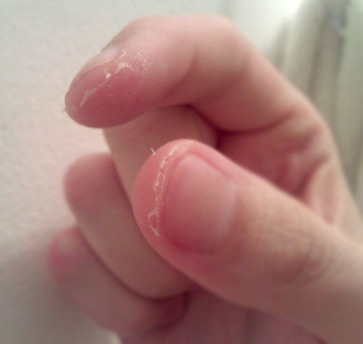 Cum to Get Rid of Peeling Fingertips