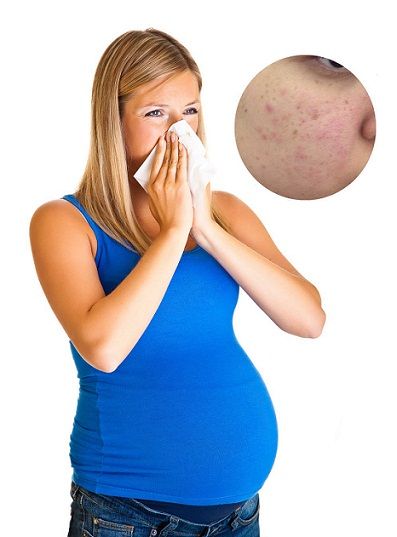 Terhesség acne