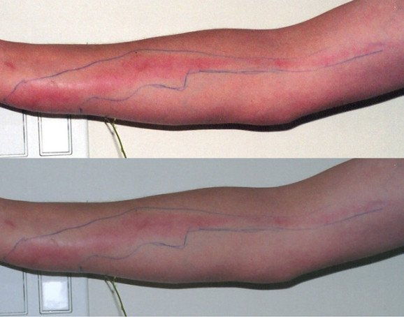 Hogyan to Identify and Fix an Infected Tattoo
