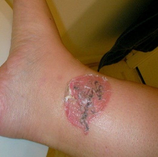 Kaip to Identify and Fix an Infected Tattoo