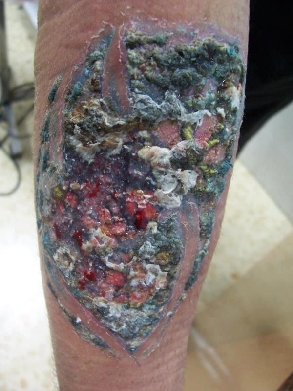 Cum to Identify and Fix an Infected Tattoo