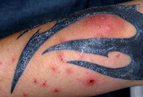 Hogyan to Identify and Fix an Infected Tattoo
