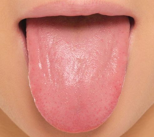 pimples on tongue