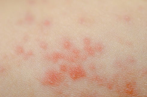 alergic rash dermatitis eczema skin