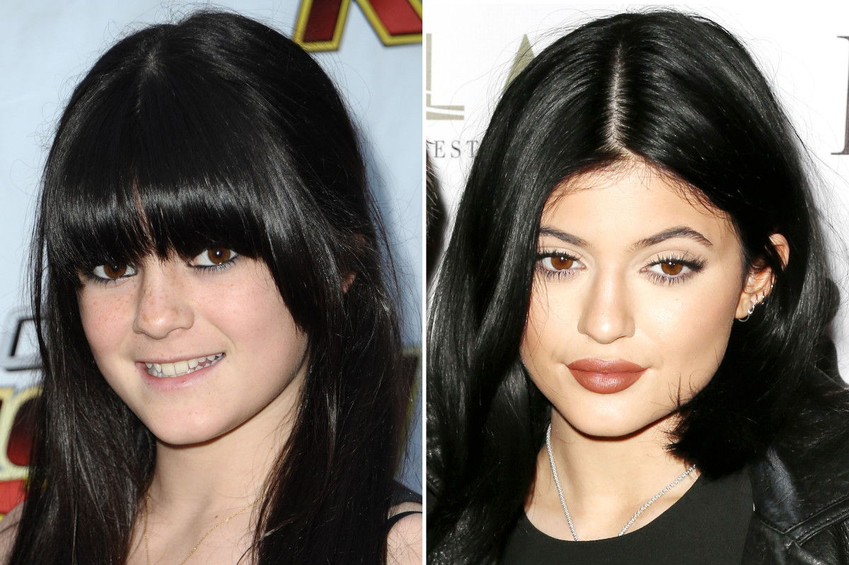 Kylie Jenner, înainte și după
