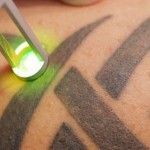 Laser Tattoo Removal | How to get your tattoo removed