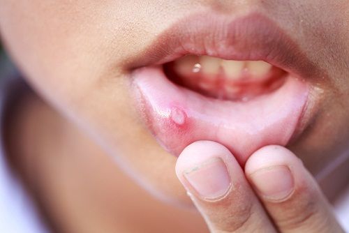 Burna ulcers during pregnancy