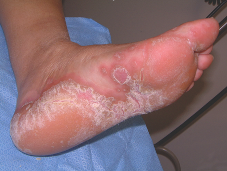 Natural Home Remedies For Fungal Infections