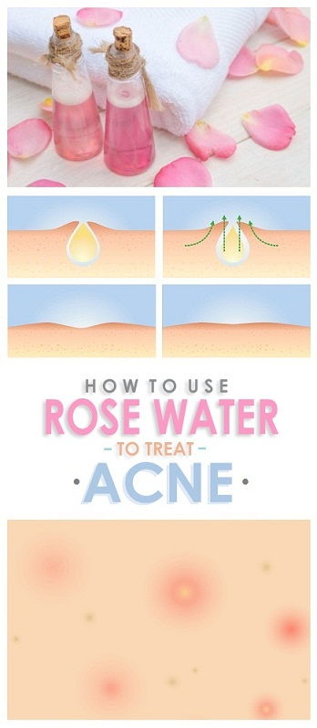 Rožė Water for Acne