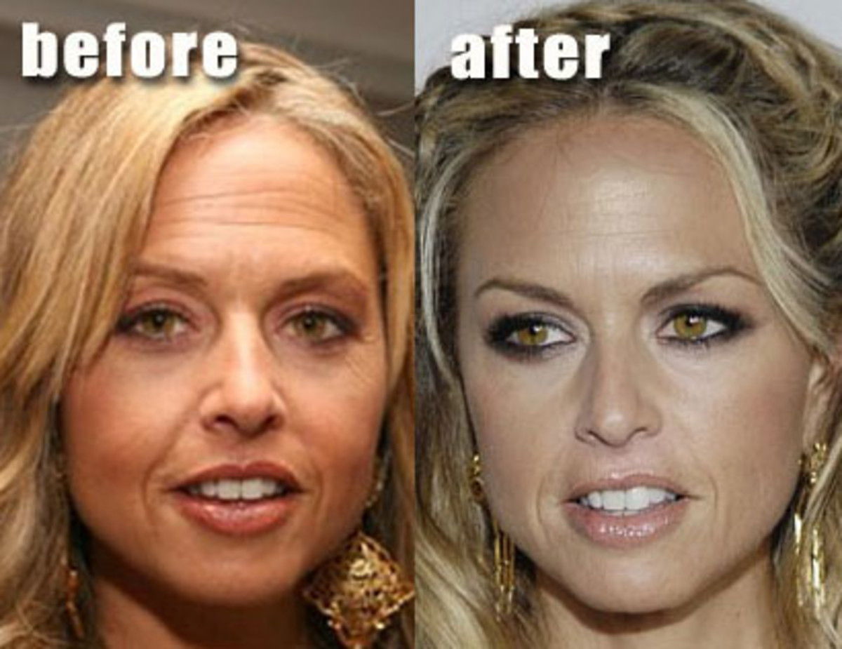 These Celebs are Examples of Good Plastic Surgery