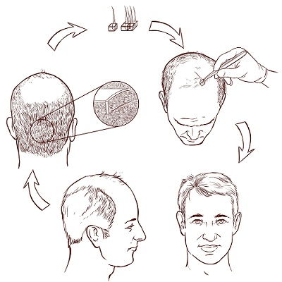 hair transplant centers in bangalore
