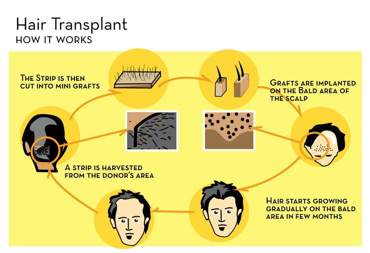 lasje transplant in delhi