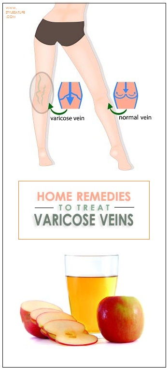 namai remedies for varicose veins