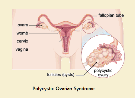 polichistic Ovarian Syndrome