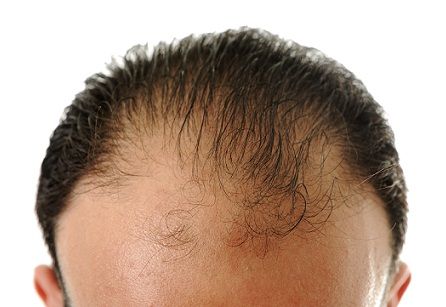 Ereditar Hair Loss