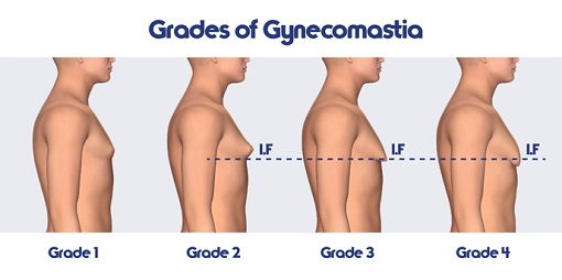 Ce este ginecomastia (Boobs masculin) si cum le poti trata in mod natural?